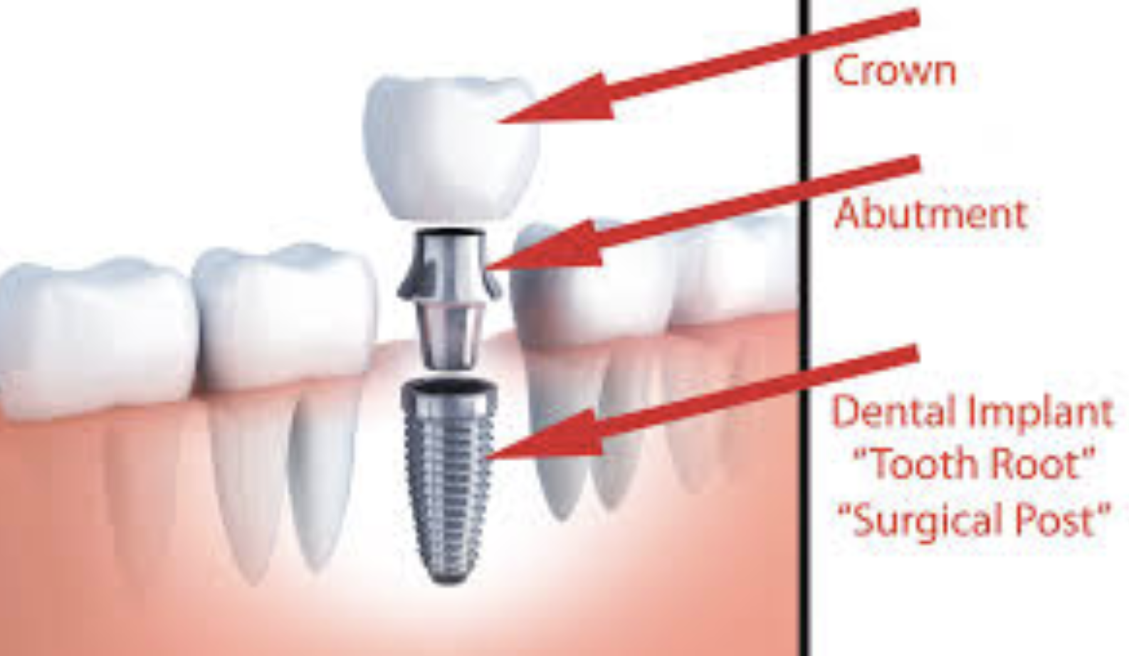 Implants