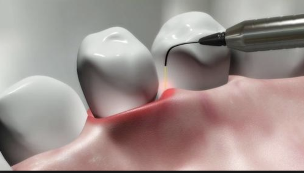 Laser Dentistry